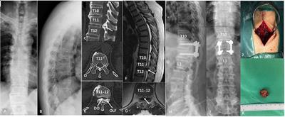 Analysis of the surgical strategy and postoperative clinical effect of thoracic ossification of ligament flavum with dural ossification